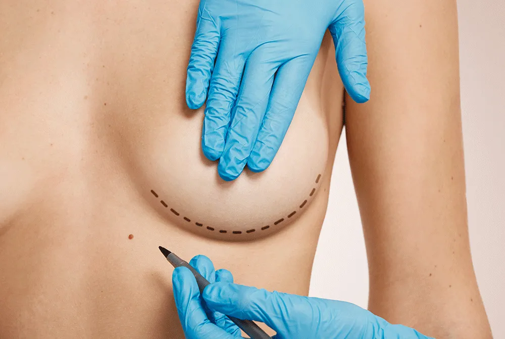 Breast Lift